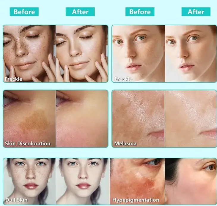Dark Spot Remover For Face, Dark Spot Cream