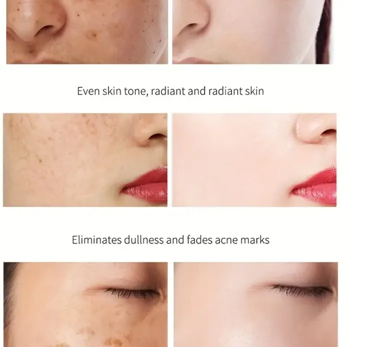 Whitening And Freckle Removing Dark Spot Remover Cream, 7 Days To Remove Dark Spot